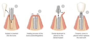 مراحل ایمپلنت های دندانی از ابتدا تا انتها !!