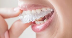 چطور می توان از شیفت دندان ها جلوگیری کرد؟