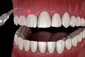 کانتورینگ لثه چه مشکلات دندانی را می تواند درمان کند؟