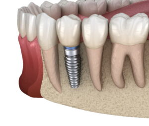 اهمیت انجام ایمپلنت های دندانی