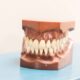 بریج دندان یا ایمپلنت دندان
