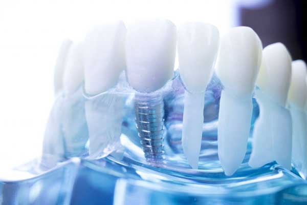 متخصص ایمپلنت دندان چه کاری برای ایمپلنت های شما می کند؟!