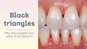 چه چیزی باعث مثلث سیاه در دندان می شود؟