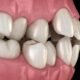 آیا بایت بد تاثیری روی ایمپلنت دندان دارد؟