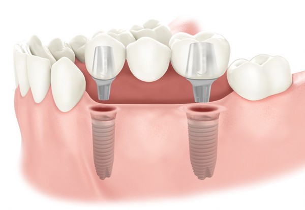 دندان های مصنوعی یا ایمپلنت