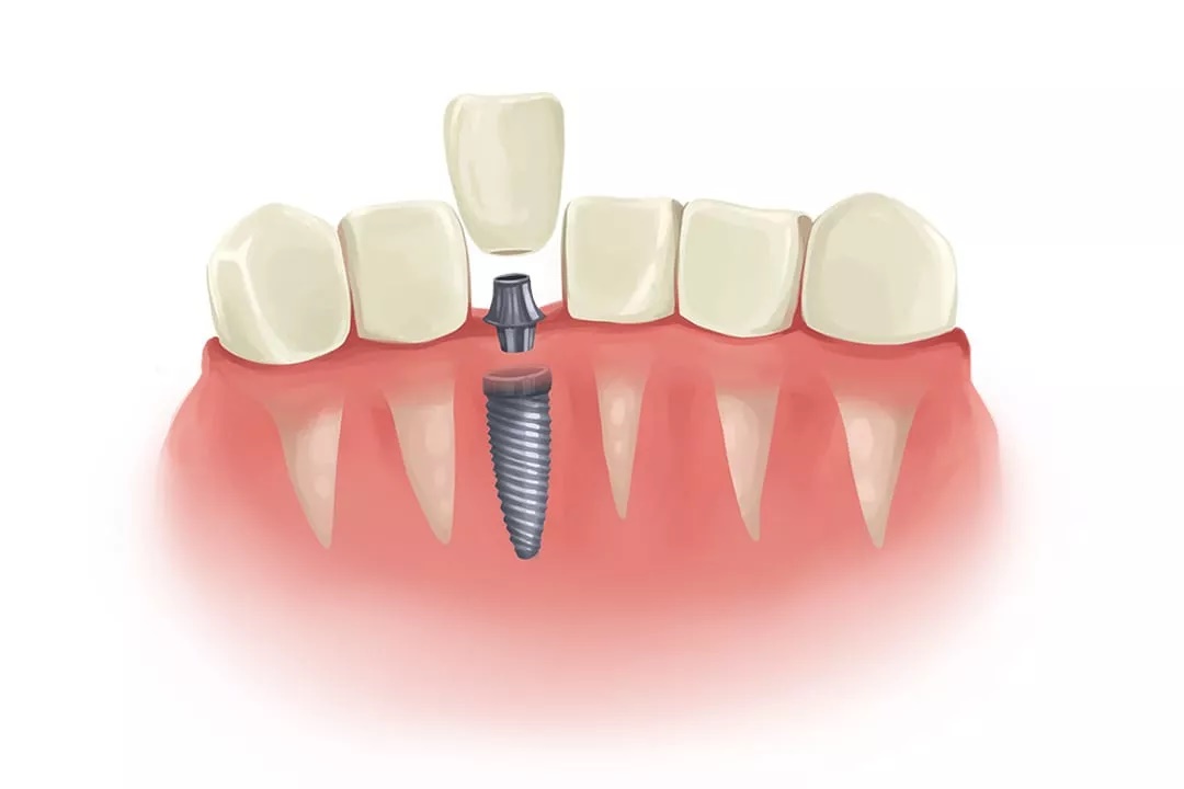 ایمپلنت های دندانی