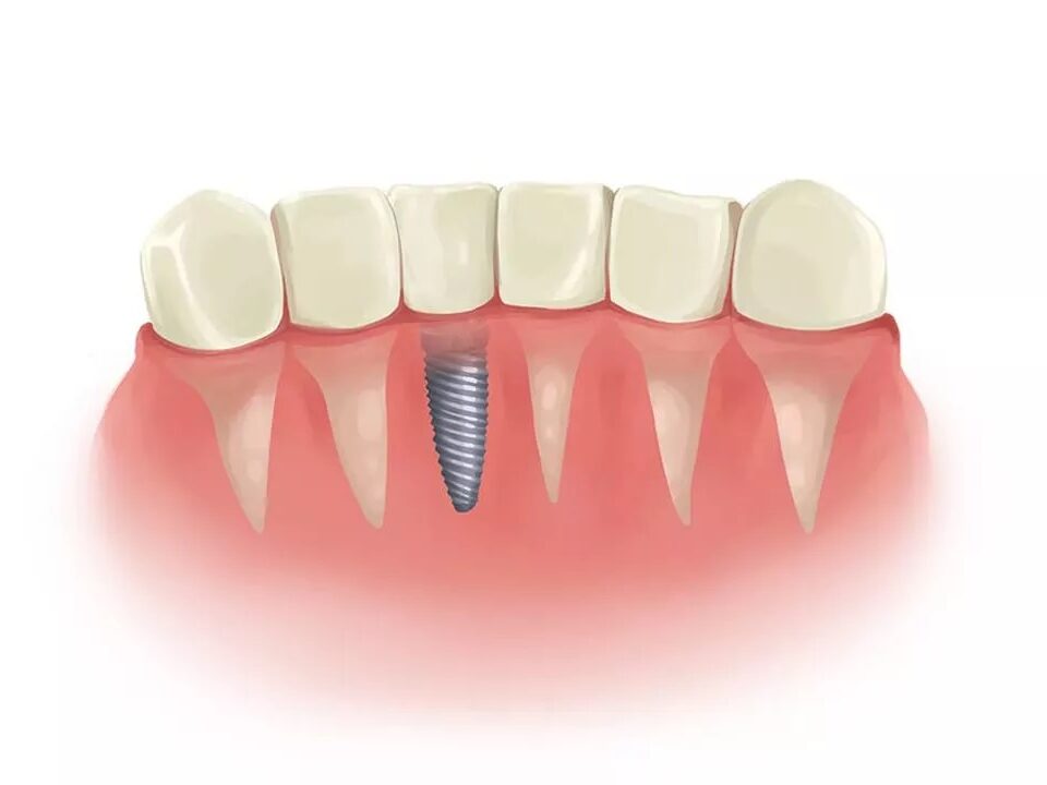 جایگزینی دندان با کاشت ایمپلنت دندان