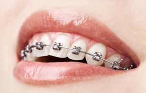 آیا ارتودنسی را در هر سنی میتوان انجام داد؟