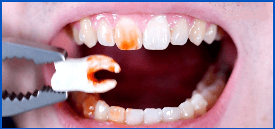 اقدامات لازم بعد از کشیدن دندان