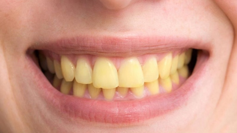 دلیل زرد شدن دندان چیست